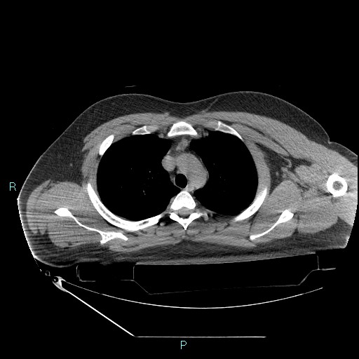 Bronchial carcinoid tumor (Radiopaedia 78272-90870 Axial non-contrast 27).jpg