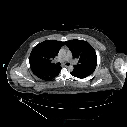 File:Bronchial carcinoid tumor (Radiopaedia 78272-90870 Axial non-contrast 42).jpg