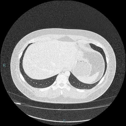 Bronchial carcinoid tumor (Radiopaedia 78272-90875 Axial lung window 46).jpg