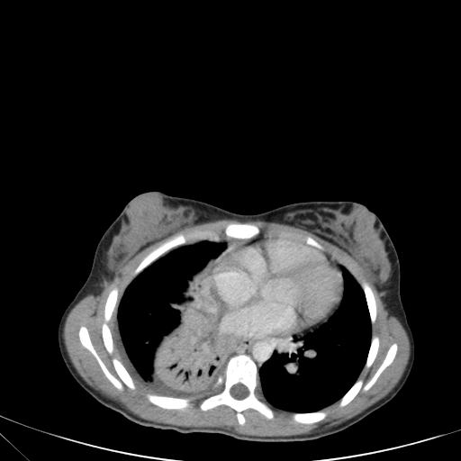 Bronchial mucoepidermoid carcinoma (Radiopaedia 57023-63895 Axial 61).jpg