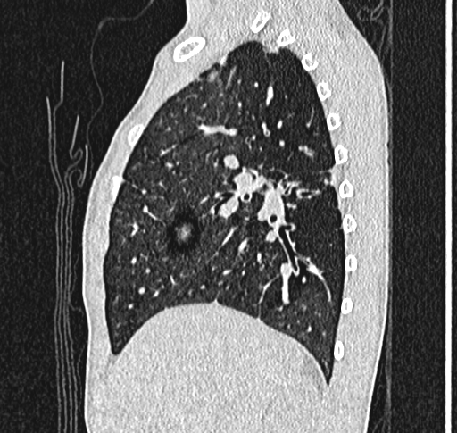 Bronchiolitis obliterans (Radiopaedia 71538-81897 Sagittal lung window 20).jpg