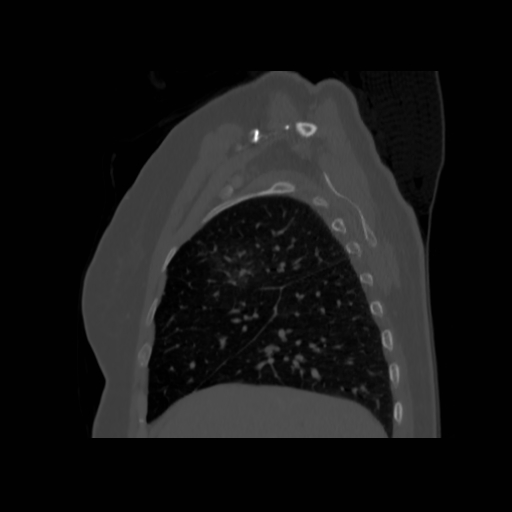 Bronchogenic carcinoma (Radiopaedia 73497-84262 Sagittal bone window 47).jpg