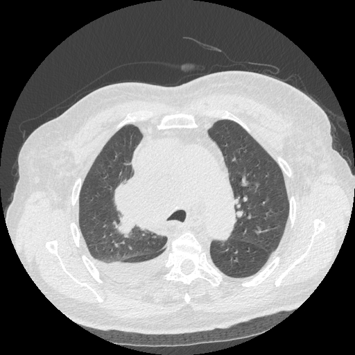 Bronchogenic carcinoma with metastatic lymphadenopathy (Radiopaedia 37671-39569 Axial lung window 18).jpg