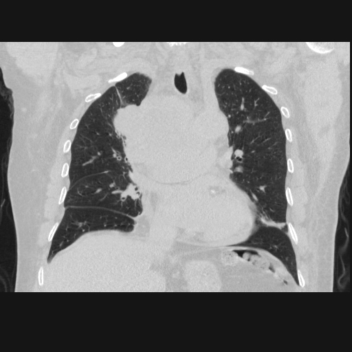 File:Bronchogenic carcinoma with metastatic lymphadenopathy (Radiopaedia 37671-39569 Coronal lung window 22).jpg