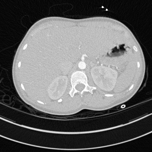 Bronchogenic cyst (Radiopaedia 77801-90071 Axial lung window 87).jpg