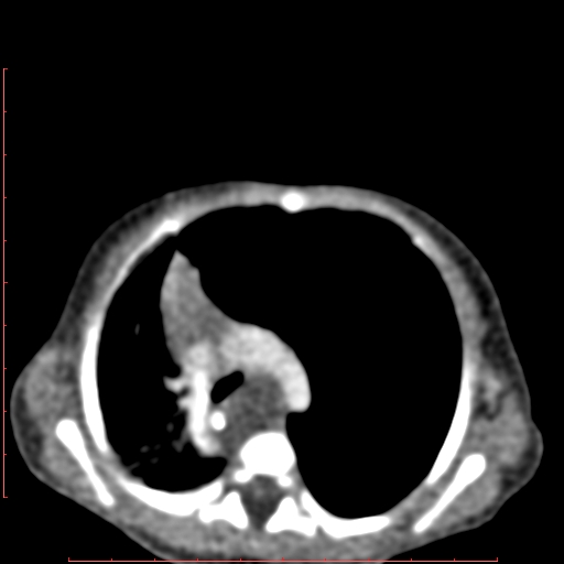 Bronchogenic cyst (Radiopaedia 78599-91409 B 82).jpg