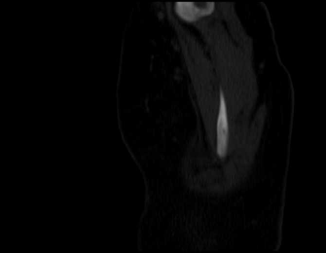 Brown tumors compressing the spinal cord (Radiopaedia 68442-77988 Sagittal bone window 3).jpg