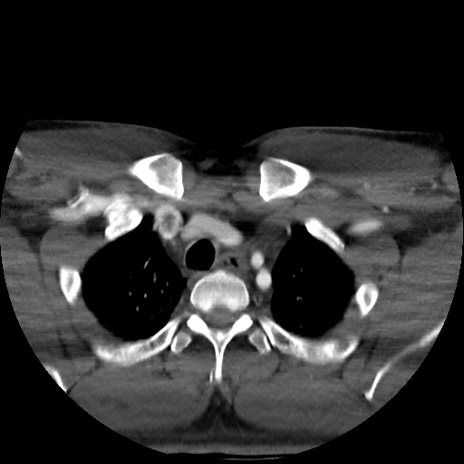 Buccal fat pad arteriovenous malformation (Radiopaedia 70936-81144 A 101).jpg