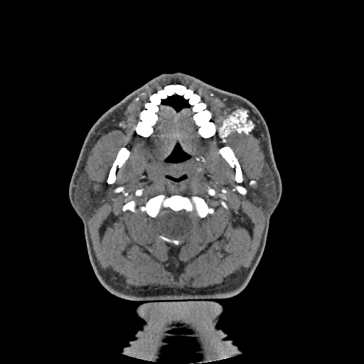 Buccal fat pad arteriovenous malformation (Radiopaedia 70936-81144 D 199).jpg