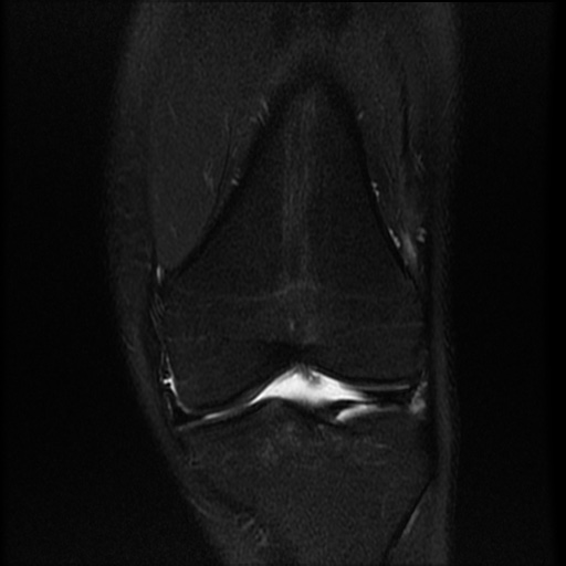 File:Bucket-handle meniscus tear (Radiopaedia 65700-74809 Coronal T2 fat sat 13).jpg