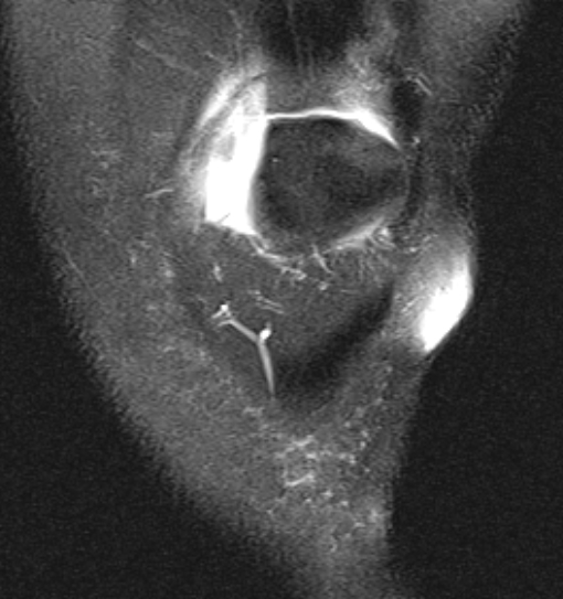 File:Bucket handle tear - medial meniscus (Radiopaedia 79028-91942 Coronal PD fat sat 21).jpg
