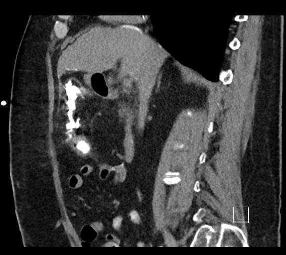 Buried bumper syndrome - gastrostomy tube (Radiopaedia 63843-72577 Sagittal Inject 73).jpg