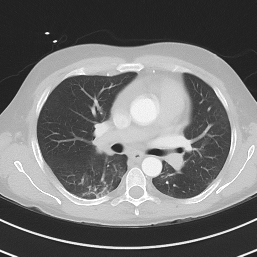 Burkitt lymphoma (Radiopaedia 34686-36121 Axial lung window 23).png
