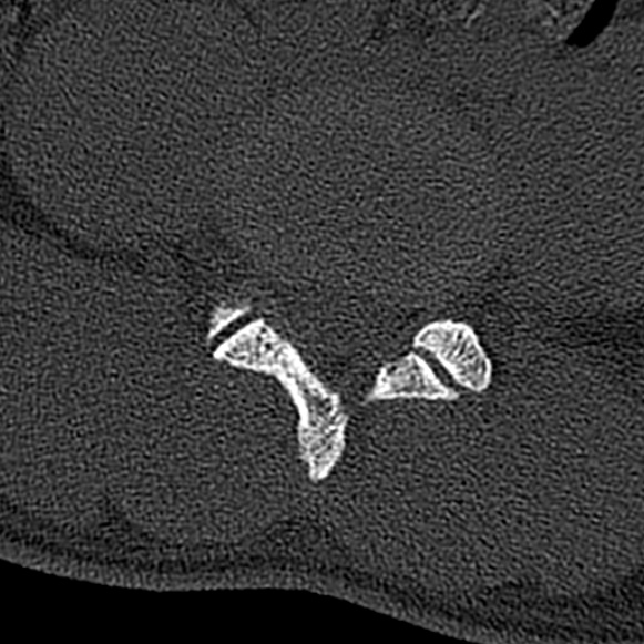 Burst fracture (Radiopaedia 53373-59357 Axial bone window 52).jpg
