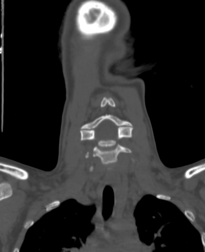 File:Butterfly vertebra (Radiopaedia 77903-90209 Coronal bone window 16).jpg
