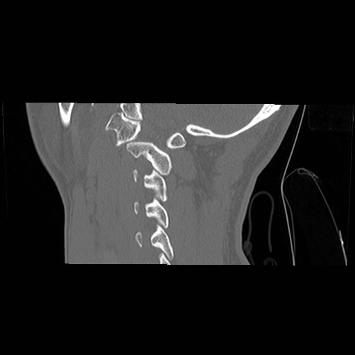 File:C1-C2 "subluxation" - normal cervical anatomy at maximum head rotation (Radiopaedia 42483-45607 C 16).jpg