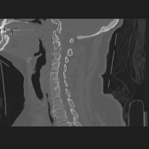 File:C2 fracture (Radiopaedia 34091-35341 Sagittal bone window 32).png