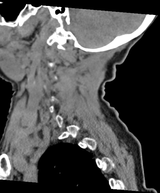 C2 fracture with vertebral artery dissection (Radiopaedia 37378-39199 D 58).png