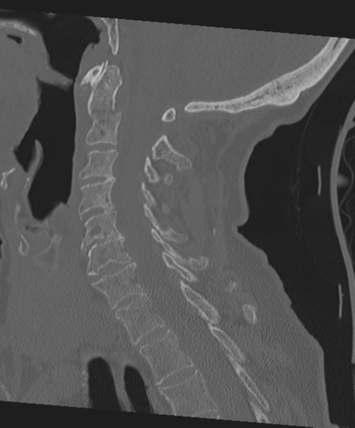C2 fracture with vertebral artery dissection (Radiopaedia 37378-39199 Sagittal bone window 42).png