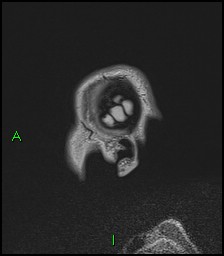 CNS manifestations of NF1 - optic pathway glioma, neurofibroma, dural ectasia (Radiopaedia 37874-39805 Sagittal FLAIR 9).jpg