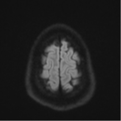 File:CNS vasculitis (Radiopaedia 55715-62263 Axial DWI 56).png