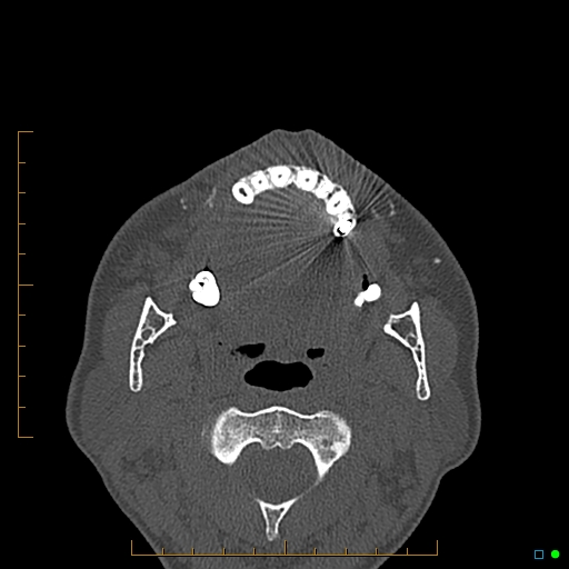 Calcified facial augmentation fillers (Radiopaedia 79514-92679 Axial bone window 96).jpg
