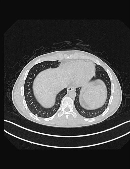Calcifying pulmonary metastases (Radiopaedia 33359-34396 Axial lung window 50).jpg