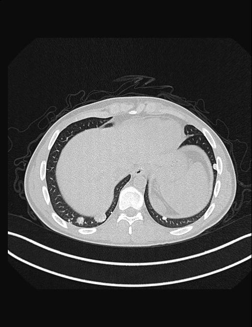 Calcifying pulmonary metastases (Radiopaedia 33359-34396 Axial lung window 52).jpg