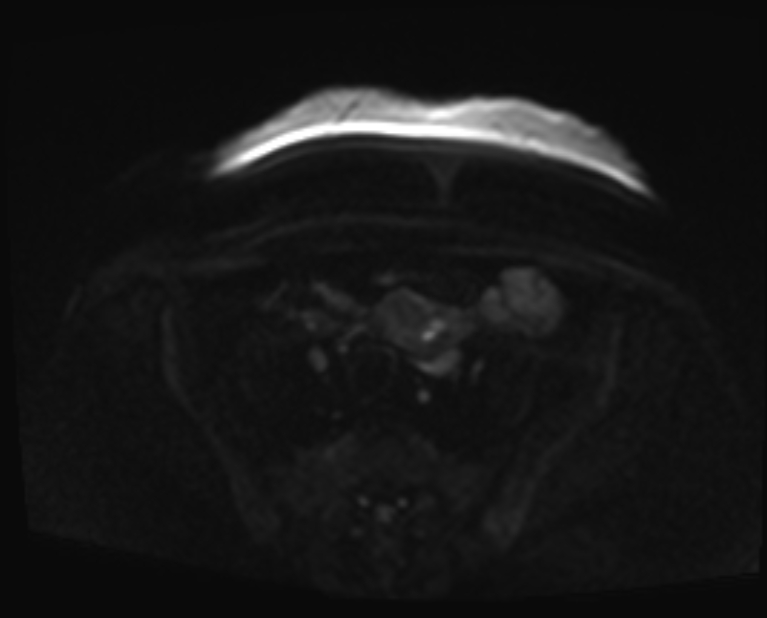 Cancer cervix - stage IIb (Radiopaedia 75411-86615 Axial DWI 54).jpg