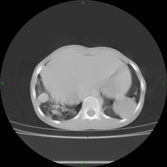 File:Cannon ball metastases - synovial sarcoma (Radiopaedia 26135-26271 Axial lung window 32).jpg
