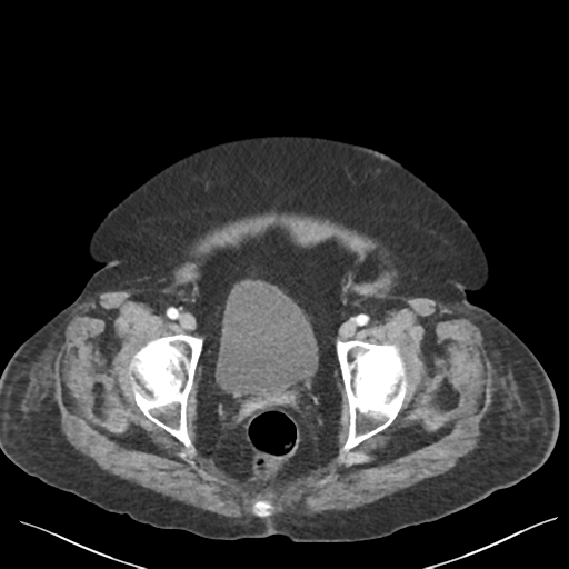 Cannonball metastases from endometrial cancer (Radiopaedia 42003-45031 E 70).png