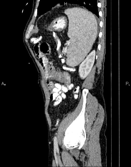 Caput medusae sign - portal hypertension (Radiopaedia 64007-72759 B 69).jpg