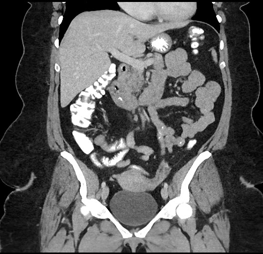 Carcinoid tumor - terminal ileum (Radiopaedia 60931-68739 B 36).jpg