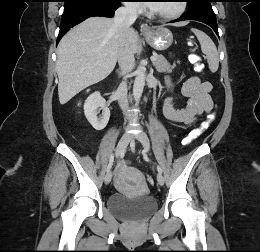 Carcinoid tumor - terminal ileum (Radiopaedia 60931-68739 B 48).jpg