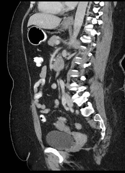 Carcinoid tumor - terminal ileum (Radiopaedia 60931-68739 C 41).jpg