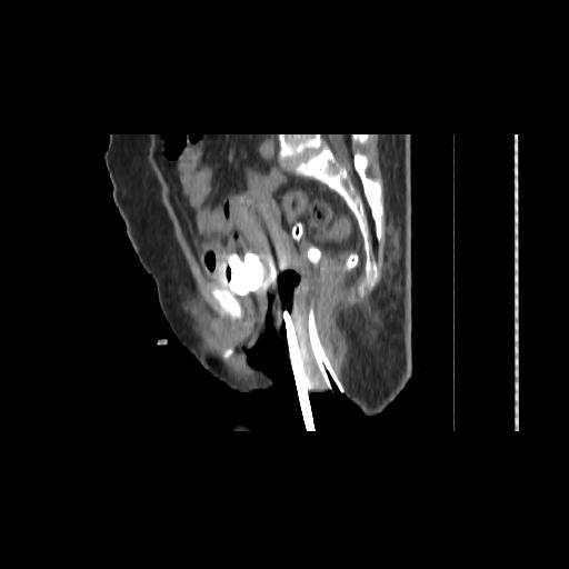 File:Carcinoma cervix- brachytherapy applicator (Radiopaedia 33135-34173 D 92).jpg