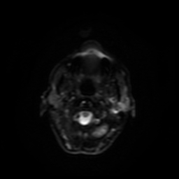 Carcinoma ex-pleomorphic adenoma of parotid (Radiopaedia 28383-28627 Ax DWI B-500 GE 18).jpg