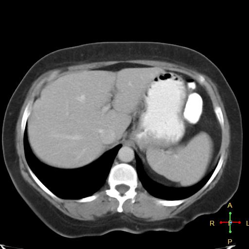 File:Carcinoma of sigmoid colon (Radiopaedia 23071-23100 B 3).jpg