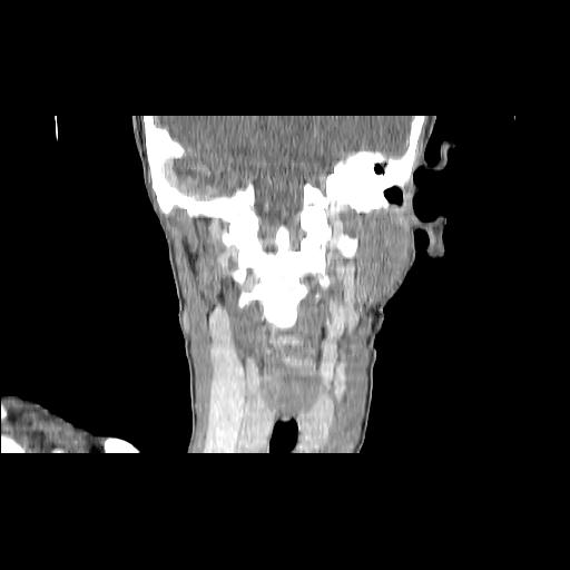 Carcinoma of the maxillary antrum (Radiopaedia 53805-59888 Coronal C+ delayed 107).jpg