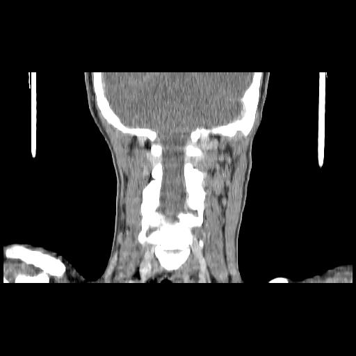 Carcinoma of the maxillary antrum (Radiopaedia 53805-59888 Coronal C+ delayed 124).jpg