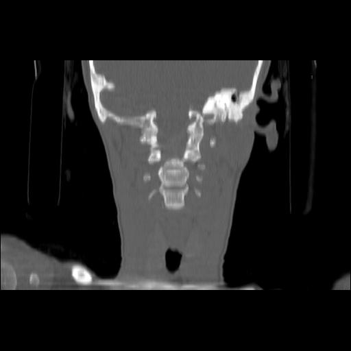 Carcinoma of the maxillary antrum (Radiopaedia 53805-59888 Coronal bone window 100).jpg