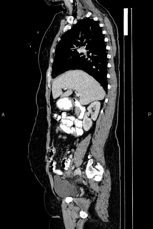 Carcinoma of uterine cervix (Radiopaedia 85861-101700 D 27).jpg