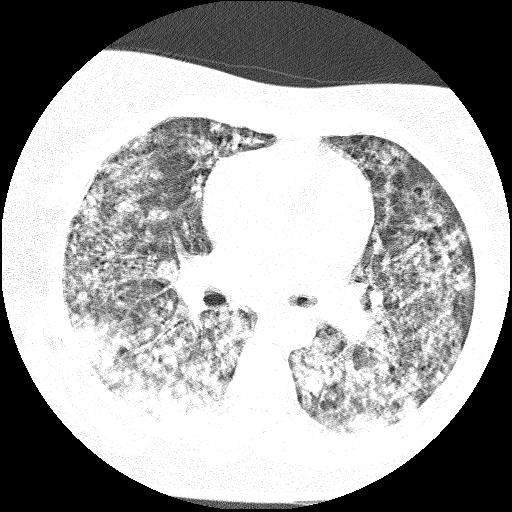Cardiac angiosarcoma (Radiopaedia 66010-75181 Axial lung window 52).jpg