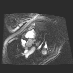 File:Cardiac fibroma (Radiopaedia 38974-41150 4 chamber FGRET 2).jpg