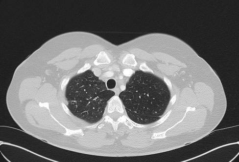 File:Cardiac sarcoidosis (Radiopaedia 74548-85534 Axial lung window 15).jpg