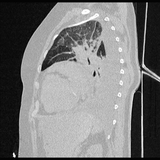 Cardiogenic pulmonary edema (Radiopaedia 29213-29609 Sagittal lung window 66).jpg