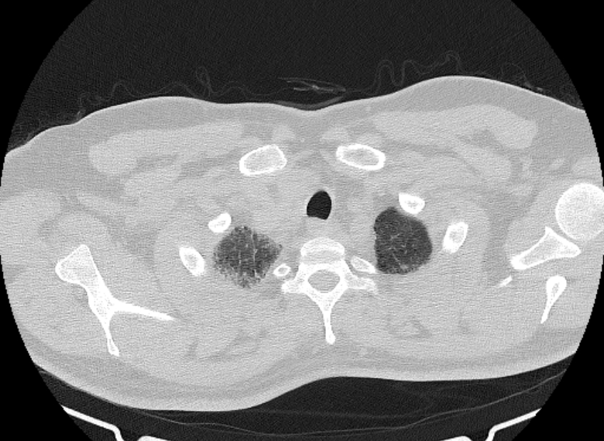 Cardiogenic pulmonary edema (Radiopaedia 68180-77678 Axial lung window 3).jpg