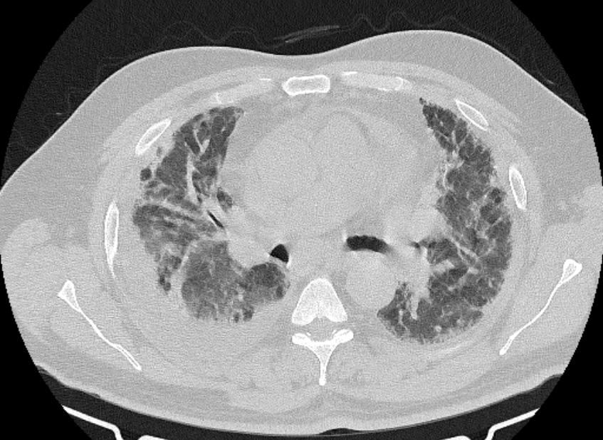 Cardiogenic pulmonary edema (Radiopaedia 68180-77678 Axial lung window 39).jpg