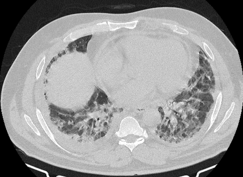 Cardiogenic pulmonary edema (Radiopaedia 68180-77678 Axial lung window 63).jpg