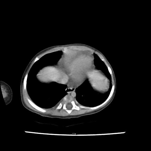 Caroli disease with autosomal recessive polycystic kidney disease (ARPKD) (Radiopaedia 89651-106703 B 11).jpg